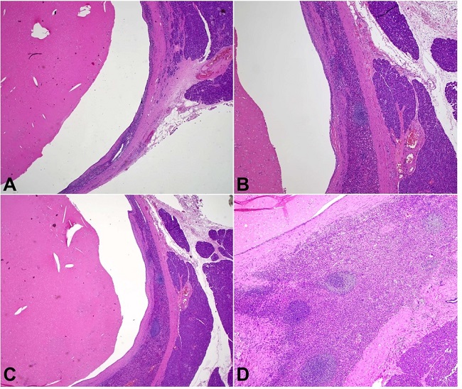 Photomicrographs of the cystic pancreatic lesion. A and B – H&E sections show a well-circumscribed, intrapancreatic unilocular cyst with a rim of splenic tissue. Normal pancreatic parenchyma is on the right side (20x); C and D – H&E sections show typical red pulp and white pulp of the splenic tissue (40x).
