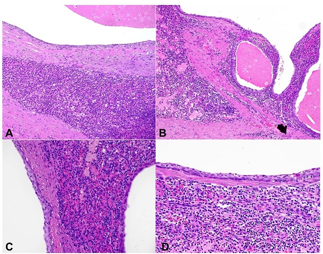 Photomicrographs of the cystic pancreatic lesion. 4A to 4D. H&E sections show cyst lining composed of bland, non-keratinizing squamous epithelium with adjacent splenic tissue (A and B – 100x; C and D – 200x).