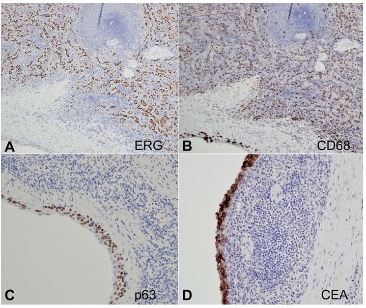 Photomicrographs of the cystic pancreatic lesion. Immunostainings show co-expression of A – ERG and B – CD68 of the littoral cells in splenic tissue (100x); positivity for (C) p63 and (D) CEA in the squamous cells (200x).