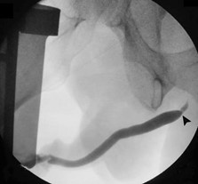 Retrograde urethrogram shows proximal short and narrow bulbar urethral stricture (arrowhead).