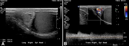 Color flow and spectral doppler of the right epididymis in sagittal plane. Results demonstrated: A – a right paratesticular (epididymal) mass (1.49 cm in greatest dimension); B – with increased vascularity.