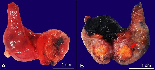 Gross examination of the resected right epididymis. A – Segment of epididymis with attached yellow, lobulated adipose tissue and tan, pink, smooth external surface. B – Cut section through the specimen revealed an irregular, bright yellow, solid mass that measured 1.1 x 0.8 x 0.8 cm, located at 0.2 cm from the resection margin.