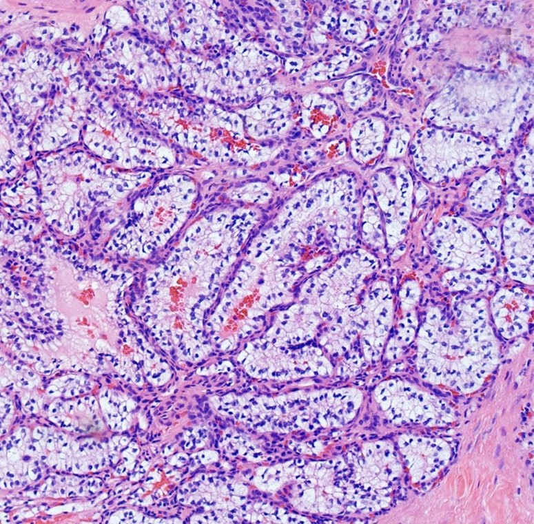 Photomicrographs of the epididymis showing epididymal mass with clear cell neoplasm and tubular/glandular morphology (H&E, 20x objective).