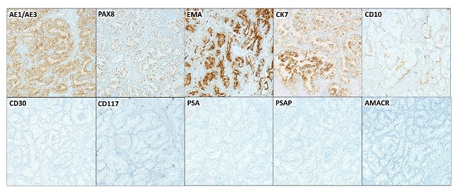 Photomicrographs of the epididymis examination using immunohistochemical stains. Tumor cells were positive for pankeratin (AE1/AE3), PAX8, EMA, and CK7. CD10 stain showed equivocal weak focal staining. PSA, PSAP, racemase (AMACR), CD30, and CD117 were all negative. Microscopic images were examined at 20x objective.