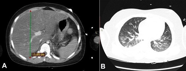 A &ndash; The abdominal CT scan shows unevenly distributed liver steatosis and hepatomegaly; B &ndash; CT scan of the lungs shows peribronchial parenchymal consolidation and a small amount of fluid in both pleural cavities.