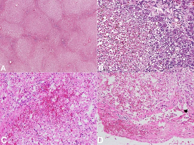 Photomicrographs of: A &ndash; Liver &ndash; the areas of centrilobular necrosis and passive and passive sinusoidal congestion with relatively preserved periportal hepatocytes (H&E, 4X); B &ndash; Early hepatocyte necrosis and passive sinusoidal congestion (left side) and preserved hepatocytes with features of steatosis (right side) (H&E, 20X); C, D &ndash; The areas of petechial bleedings in liver parenchyma and the subcapsular area (H&E, 40X).