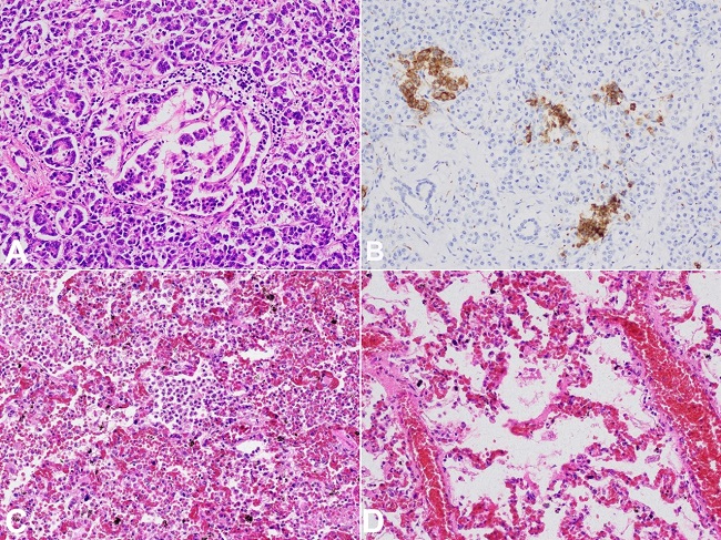 Photomicrographs of: A &ndash; Pancreas &ndash; pancreatic islet with disturbed architecture, surrounded by lymphocytic infiltrate (H&E, 40X); B &ndash; Pancreas - abnormal pancreatic islet structure highlighted by synaptophysin staining (20X); C &ndash; Lungs &ndash; area of early bronchopneumonia (H&E, 20X); D &ndash; Lungs - signs of passive congestion with hyaline membranes formation (H&E, 40X).