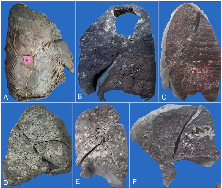 Gross findings of the lungs. A &ndash; Chronic pleuritis showing thick opaque visceral pleura with adipose tissue infiltration over entire right lung; B &ndash; Large fibrocavitary lesion in the apical segment of the left lung; C &ndash; Localized miliary lesions surrounded by congested parenchyma in lingular and basal segments; D &ndash; Tuberculous bronchopneumonia seen as multi-focal areas of grey-white consolidated areas in the right lung; E &ndash; Right lung with multiple white nodules scattered all over the parenchyma; F &ndash; Large solitary nodule with a central area of cavitation.