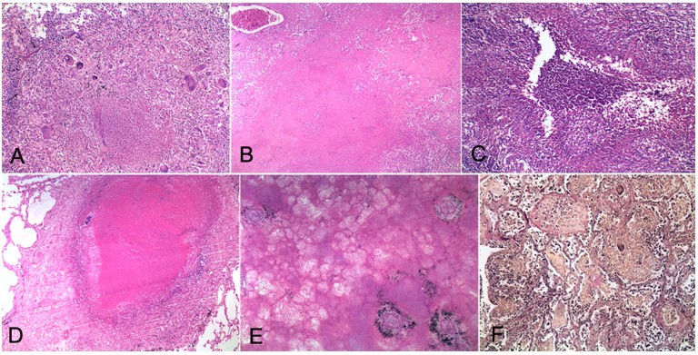 Photomicrographs of the lung. A &ndash; Caseation necrosis surrounded by epithelioid cells, Langhans giant cells and lymphocytes (H&E, 200X); B &ndash; A zone composed only of caseation necrosis (H&E, 100X); C &ndash; Necrotizing granuloma with central abscess-like reaction (H&E, 200X); D &ndash; Caseation necrosis occluding the lumen of a bronchus. A plate of cartilage is calcified with bluish discoloration (H&E, 100X); E &ndash; Occlusive arterial lesions with infarction (H&E, 100X); F &ndash; Foci of organizing pneumonia with accompanying granulomatous reaction (elastic van Gieson, 200X).