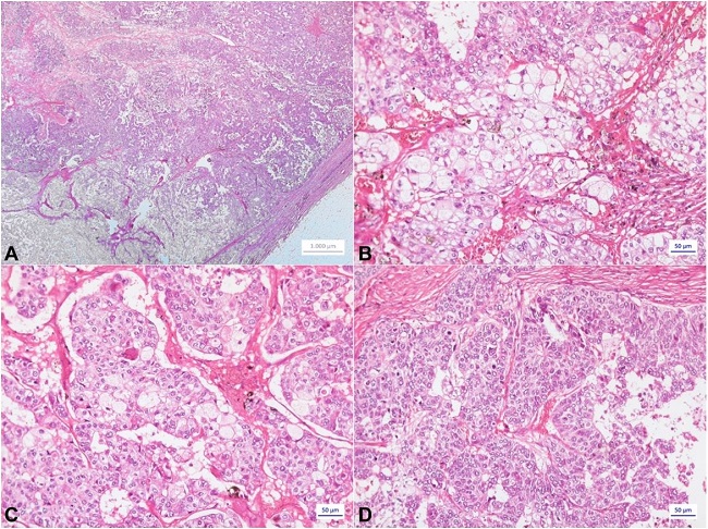 Photomicrograph of the tumor. A, B, C – Lobules of tumor cells with abundant vacuolated cytoplasm, surrounded by more basophilic tumor cells in the periphery of the lobules (HE); D – Clusters of cells without evidence of sebaceous differentiation, indistinguishable from a classic ductal carcinoma (HE).