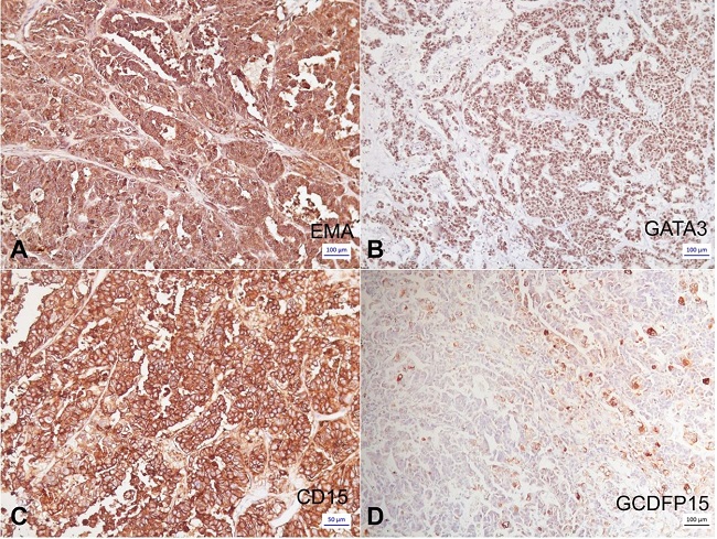 Photomicrograph of the tumor. Immunohistochemical panel. A – Positive expression of EMA in the tumor cells (100 x); B – Positive expression of GATA-3 in the tumor cells (25 x); C – Strongly positive expression of CD15 in the tumor cells with sebaceous differentiation (100 x); D – Focal positivity of GCDFP15 in the tumor Cells (25X)