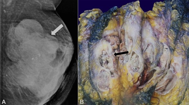 A – Mammography showing an ill-defined right breast sub-aerolar mass with eccentric lucent areas (craniocaudal view); B – Gross examination revealed a grey white tumor with multiple variably sized cysts containing friable mucoid material.