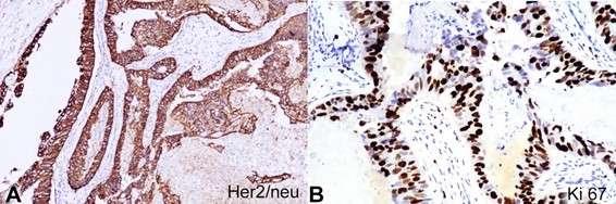 Photomicrographs of the tumor. A – Membranous positive for HER2/neu (in tumor cells (x400) ASCO/CAP guidelines IHC score 3+; B – Positive Ki 67 expression in tumor cells (x400).