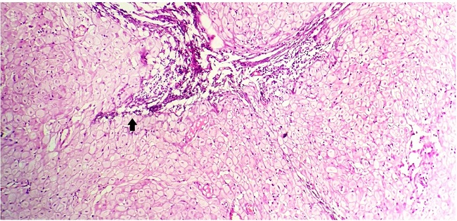 Photomicrograph of the lesion reveals multiple nodules composed of decidualized stromal cells surrounding a few slit-like endometrial glands admixed with fibroblasts and collagen. The arrow highlights the slit-like endometrial glands (H&E, 40x).