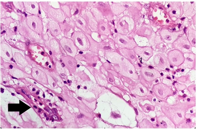 Photomicrograph of the lesion. High power view of the lesion showing the round to polygonal structure of decidual cells. The arrow highlights slit-like endometrial glands (H&E;100x).
