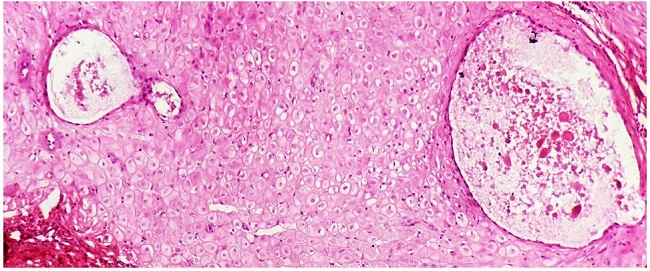 Photomicrograph of occasional dilated endometrial glands containing eosinophilic secretions seen lying amongst the decidual cells (H&E, 40x).