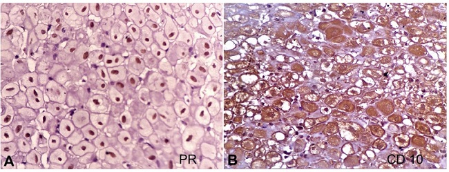 A and B &ndash; decidual cells showing positive reaction for PR and CD10 respectively (400x).