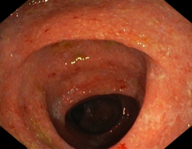Colonoscopic view of the mucosal inflammation of the descending colon with mucosal friability, edematous mucosa, erythema and loss of vascular markings.