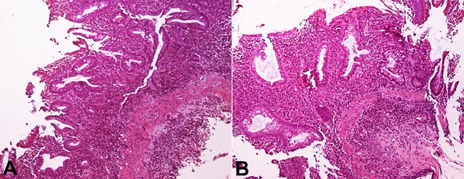 Photomicrographs of the colonic mucosal biopsy indicating ulcerative colitis. A and B &ndash; Crypt architectural distortion- basal plasmacytosis (H&E, x10) (H&E, x20).