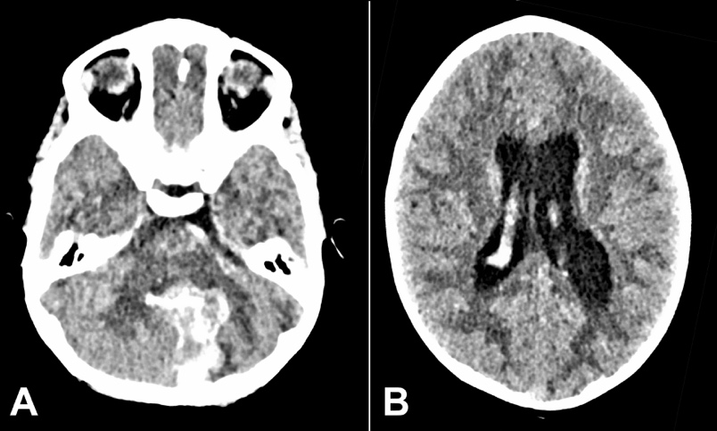A – Brain CT on the first presentation. Intracerebral hemorrhage in the cerebellar vermis and medial aspect of the left cerebellar hemisphere with intraventricular extension; B – Brain CT on first presentation showing supra-tentorial hydrocephalus.