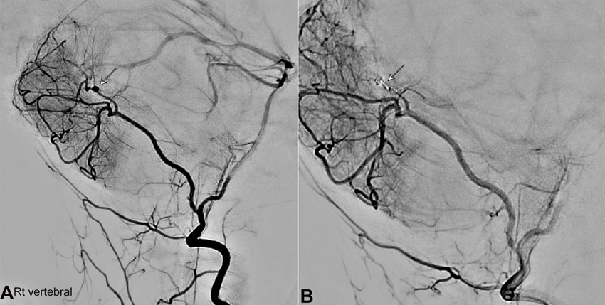 A – Digital Subtraction Angiogram (DSA) on the first presentation before coiling of the aneurysm. Arrows showing aberrant right PICA and irregular distal branches and a distal aneurysm; B – Digital Subtraction Angiography (DSA) after coiling of the aneurysm.