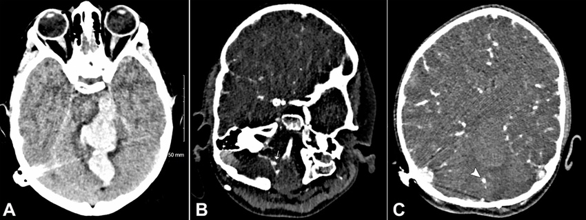 CT brain on the second presentation. A – Intracerebral hemorrhage in the cerebellar vermis with extension into the distorted fourth ventricle, the third and lateral ventricles, the quadrilateral cistern, and the left cerebral peduncle with adjacent vasogenic edema; B – CTA showing aneurysm of the right superior cerebellar artery (arrow); C – Proximal aneurysm of right PICA (arrow).