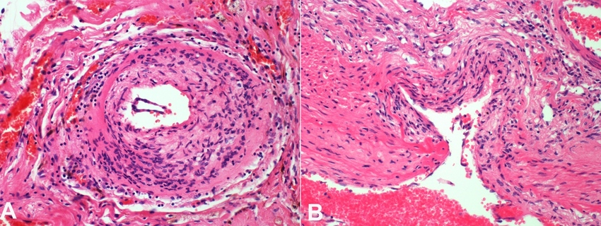 Photomicrograph of the vertebrobasilar circulation vessel. A – vertebrobasilar circulation artery showing diffuse lymphohistiocytic infiltrate; B – Histopathology of vertebrobasilar circulation artery showing loss of internal elastic lamina and foci of fibrinoid necrosis.