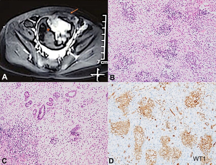 A &ndash; CEMRI with MR urography shows polypoidal, heterogeneous mass over the anterosuperior aspect of the urinary bladder wall. The mass with both endophytic (arrow head) and exophytic (arrow) growth is seen; B, C, and D are photomicrographs of the bladder tumor; B and C &ndash; Pretherapy cystoscopy guided biopsy showing triphasic component comprising blastemal (B; H&E, 200X), and epithelial and mesenchymal elements (C; H&E, 200X); D &ndash; The blastemal component positive for WT1 immunostain (200X).