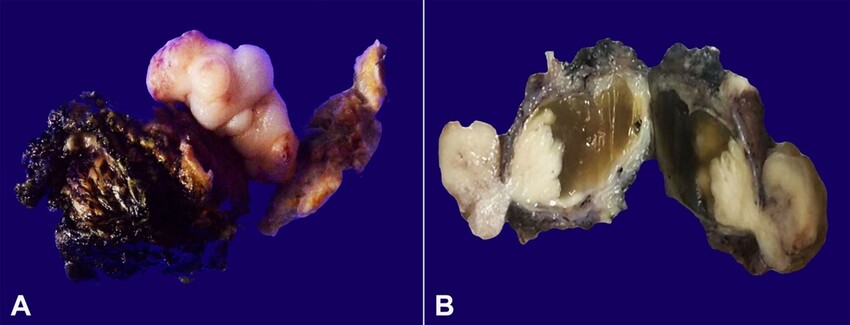 A &ndash; The partial cystectomy specimen reveals exophytic polypoidal growth; B &ndash; The cut surface shows both endophytic and exophytic growth with grey white and firm in appearance. The endophytic component is surrounded by the cystic space containing gel-like material.