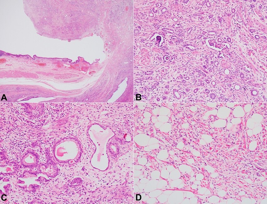 Photomicrographs of the partial cystectomy specimen showing: A &ndash; a polypoidal mass arising within the lumen. Bladder wall with detrusor muscle can be appreciated (right) (H&E, 40X); B &ndash; Biphasic component comprising of glomeruli, tubules, and smooth muscle fibers (H&E, 200X); C &ndash; Heterologous mucinous epithelium (H&E, 200X); D &ndash; Adipocytic and skeletal muscle differentiation (H&E, 200X).