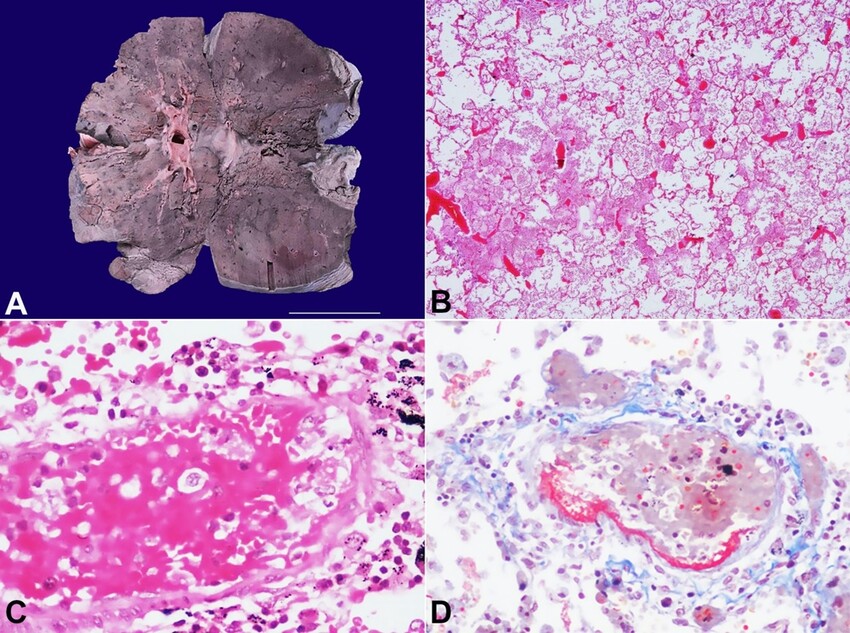 A – Gross view of the cut surface of the lung showing focal brownish discoloration. Microphotographs of the lung; B – low power examination showing marked vascular congestion with pulmonary edema (H&E, 20X); C – pre-acinar pulmonary artery showing marked congestion and evidence of endothelitis in the form of endothelial cell swelling, extravasation of RBCs, and deposition of fibrin material in their wall (H&E, 200x); D – Fibrin in the arterial wall is better highlighted on Martius Scarlet blue stain (MSB, 200X).