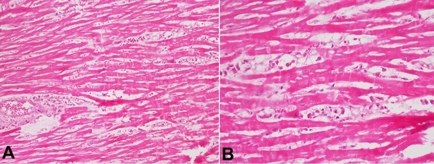 A – Photomicrographs of the myocardium showing perivascular and interstitial edema (H&E, 100X); B – and mild mixed Inflammatory cell infiltrates (H&E, 200x).