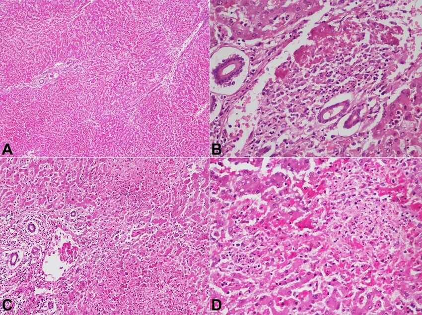 A – Photomicrographs of the liver showing maintained lobular architecture with marked sinusoidal dilatation and congestion (H&E, 20X); B – Portal tract showing fibrin thrombus in the portal vein with near-complete occlusion of their lumina (H&E, 200x); C – Hepatic lobules show multifocal hepatocyte necrosis in Zone 1 (H&E, 200X); D – and Zone 2 region (H&E,400X).