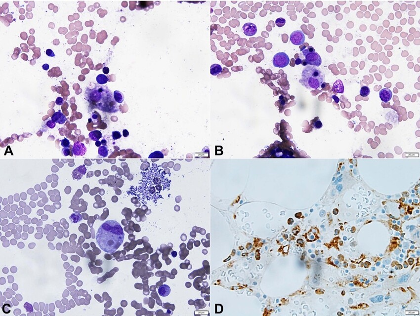 A, B and C – Photomicrographs of bone marrow aspirate demonstrating hemophagocytosis (Wright stain; 600x); D – Photomicrograph of CD68 immunostain highlighting histiocytes (600x).