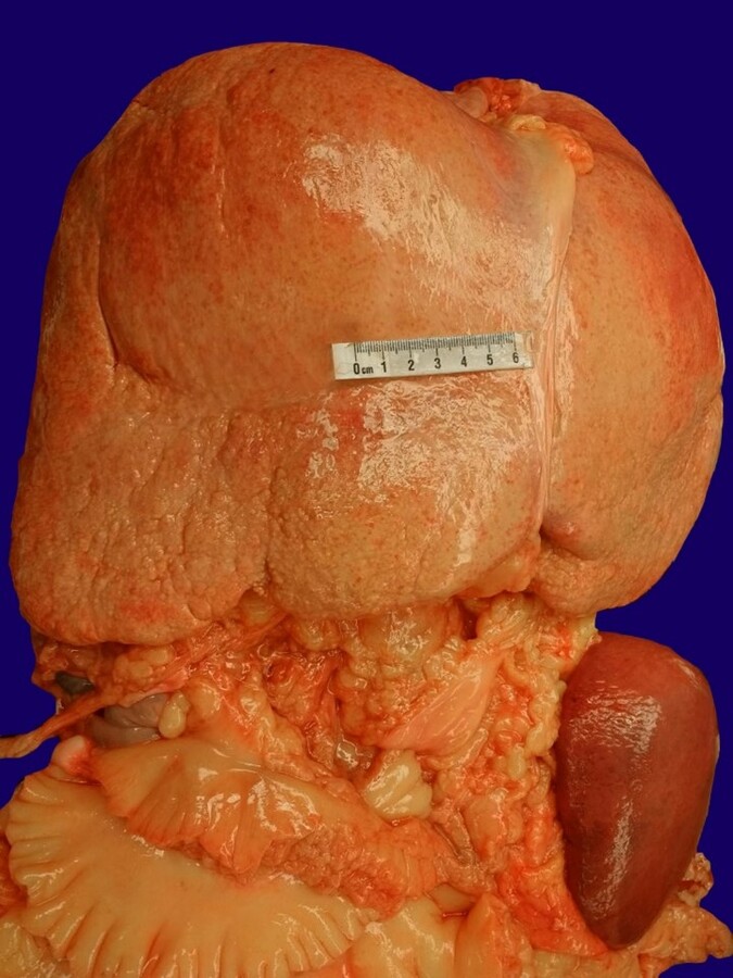 Photograph of organ block at postmortem examination highlighting the hepatosplenomegaly.
