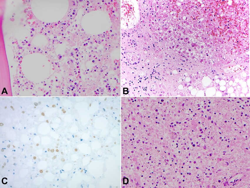 A – Photomicrograph of decalcified vertebral bone marrow sampled at autopsy demonstrating hemophagocytosis (H&E, 400x); B – Photomicrograph of liver sampled at autopsy with viral cytopathic changes, nuclear debris and macrovesicular steatosis (H&E, 200x); C – Photomicrograph of liver sampled at autopsy with macrovesicular steatosis and HSV1-2 immunopositive hepatocyte nuclei (200x); D – Photomicrograph of spleen sampled at autopsy demonstrating significant autolysis with occasional enlarged phagocytic cells present (center) (H&E, 400x).