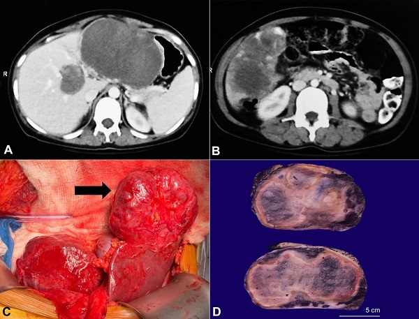 Radiology and gross images of the lesion(s). A &ndash; The CECT showing the largest hypodense lesion involving the left lobe along with its medial extension; B &ndash; The CECT showing a large heterogeneous and hypodense lesion in the right lobe with irregular margins; C &ndash; The intraoperative figure showing the large lesion in the left lobe of the liver (black arrow); D &ndash; The gross picture of the largest lesion highlighting a seemingly well-encapsulated mass with tan-brown color and a spongy honeycombed cut surface.