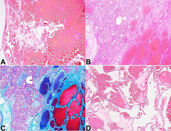 Photomicrographs of the giant cavernous hemangioma. A &ndash; Scanner view of the largest cavernous hemangioma that was well-encapsulated (H&E; 20x); B &ndash; Focal insinuation of the margin into the native hepatic parenchyma (H&E; 40x); C &ndash; highlighted in Masson trichrome stain (C; 40x); D &ndash; the higher magnification revealing multiple cystically dilated vascular spaces lined by flattened single layer of endothelium containing erythrocytes (H&E; 200x).