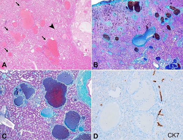Photomicrographs of the native liver parenchyma. A &ndash; Variable sized micro-angiomatous lesions characterized by irregular-shaped dilated vascular channels arranged throughout the native liver parenchyma (black arrows) along with sinusoidal dilatation (black arrowhead) (H&E; 20x); B and C &ndash; The locations of the microangiomatous lesions being portal tracts and central veins as highlighted by Masson trichrome stain (B; 20x) (C; 100x); D &ndash; The retention of the interlobular bile ducts without any ductopenia in CK7 immunostain while the vascular lesions were unstained by CK7 (peroxidase; 200x).