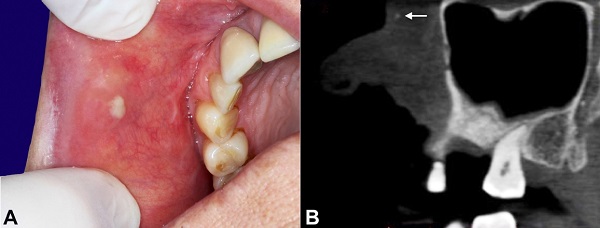 A - gross view of the buccal mucosa showing the nodular swelling with mucopurulent discharge; B - sagittal computed tomography showing a tiny hyperdense structure in the lesional area (white arrow).