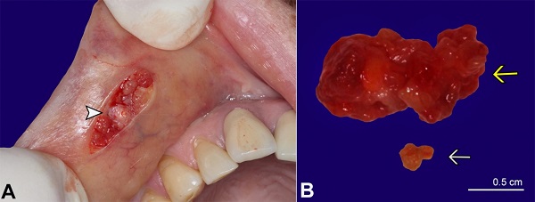 A - gross view of the surgical field enabling the visualization of the sialolith (arrowhead); B - excised specimens. The yellow arrow shows the solid mass with a smooth surface, while the white arrow shows the sialolith measuring 0.3 &times; 0.2 &times; 0.1 cm.
