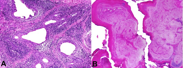 A - photomicrographs of the surgical specimen exhibiting fibrous stroma, acinar atrophy, and dilated ducts surrounded by chronic inflammation (H&E stain, &times;10); B - histopathological features showing a homogeneous calcified structure in a concentric pattern (H&E stain, &times;10).
