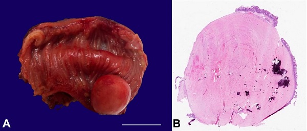 A &ndash; Gross appearance of the tumor in the segment of the small bowel (scale bar= 2 cm); B &ndash; Photomicrograph demonstrating whole-mount view of the tumor (H&E 5x).