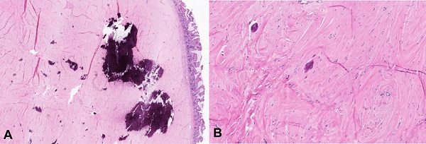 A &ndash; Medium power photomicrograph showing the tumor in relation to overlying normal mucosa (A- H&E 10x); High power photomicrograph showing scant spindle cells embedded in a dense, hyalinized and calcified, collagenous stroma (B- H&E 20x).