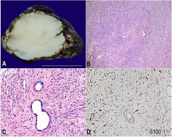 A &ndash; Cut-section of the 2.5 x 2.0 x 1.0 cm tumor showing an encapsulated, homogenous, tan-whitish tumor, B, C and D &ndash; Photomicrographs of the tumor; B &ndash; slender background spindle cells and scattered glands (H&E x40); C &ndash; slender background spindle cells with scattered glands. A myoepithelial cell layer surrounded some glands but not others. The glands appeared to be lined by a single layer of luminal cuboidal cells(H&E x200); D &ndash; positive S100 immunohistochemical reaction in the background spindle cells. (x100).