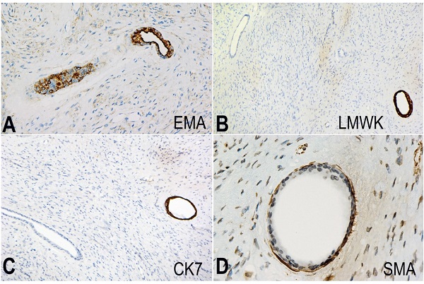 Photomomicrographs of the tumor. A &ndash; Epithelial membrane antigen (EMA) stain expressed by the epithelial cells. (EMA x200); B &ndash; The luminal cells of some of the glands expressed the low molecular weight keratin stain (LMWK x100); C &ndash; The luminal cells of some of the expressed the cytokeratin stain (CK7 x100); D &ndash; The smooth muscle actin stain was expressed by the myoepithelial cell layer that was present in some of the glands in this neurofibroma. Note: not all the glands were positive for this stain. (SMA x400).