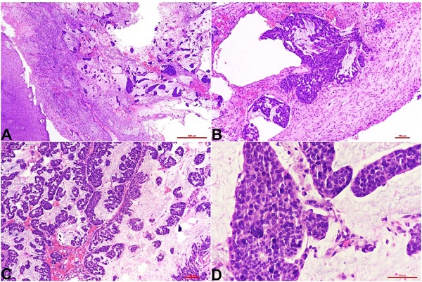 Photomicrographs of the histopathology of gingival soft tissue exhibiting hyperplastic uninvolved squamous mucosa with the subepithelial infiltration by tumor cells arranged in papillae and clusters embedded in pools of mucin; H&E stain, A - 4X, B and C - 10X, and D - 40X.