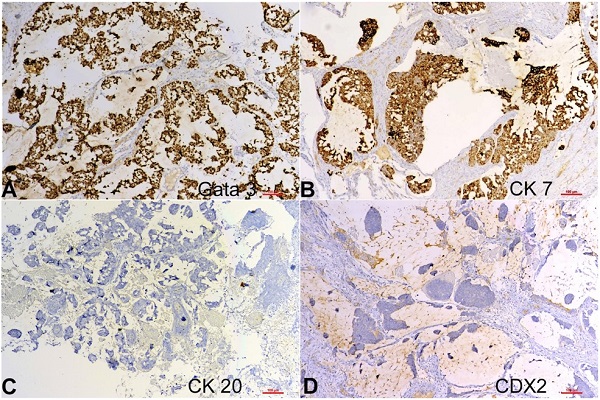 Photomicrographs of the tumor in Figure 1 displaying immunohistochemical positivity for A - GATA3 and B - CK7 and negativity for C - CK20 and D - CDX2; (A, B, C, D) 10X.
