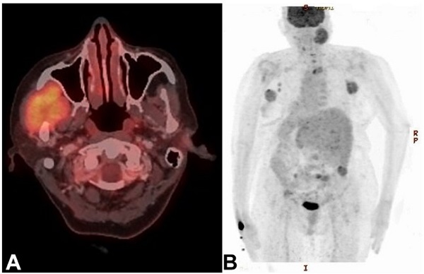 Positron emission tomography (PET) scan demonstrating: A - enhancing destructive lytic lesion involving ramus and coronoid process of the right mandible and adjacent soft tissues, and B - hypermetabolic left axillary nodes and skeletal metastases involving lamina of C7, D1, and D3 vertebra, left acetabulum, bilateral iliac bones, sacrum, and right scapula with associated soft tissue components.