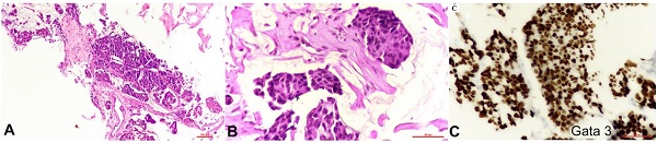 Photomicrographs of the histopathology of mucinous breast carcinoma showing A and B - tumor cells in extracellular pools of mucin (10X and 40X respectively); B - positive reaction for GATA3 on immunohistochemistry (40X).
